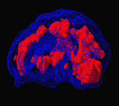 Ptsd Brain Scans